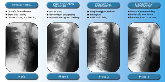 Degeneration True Health Chiropractic